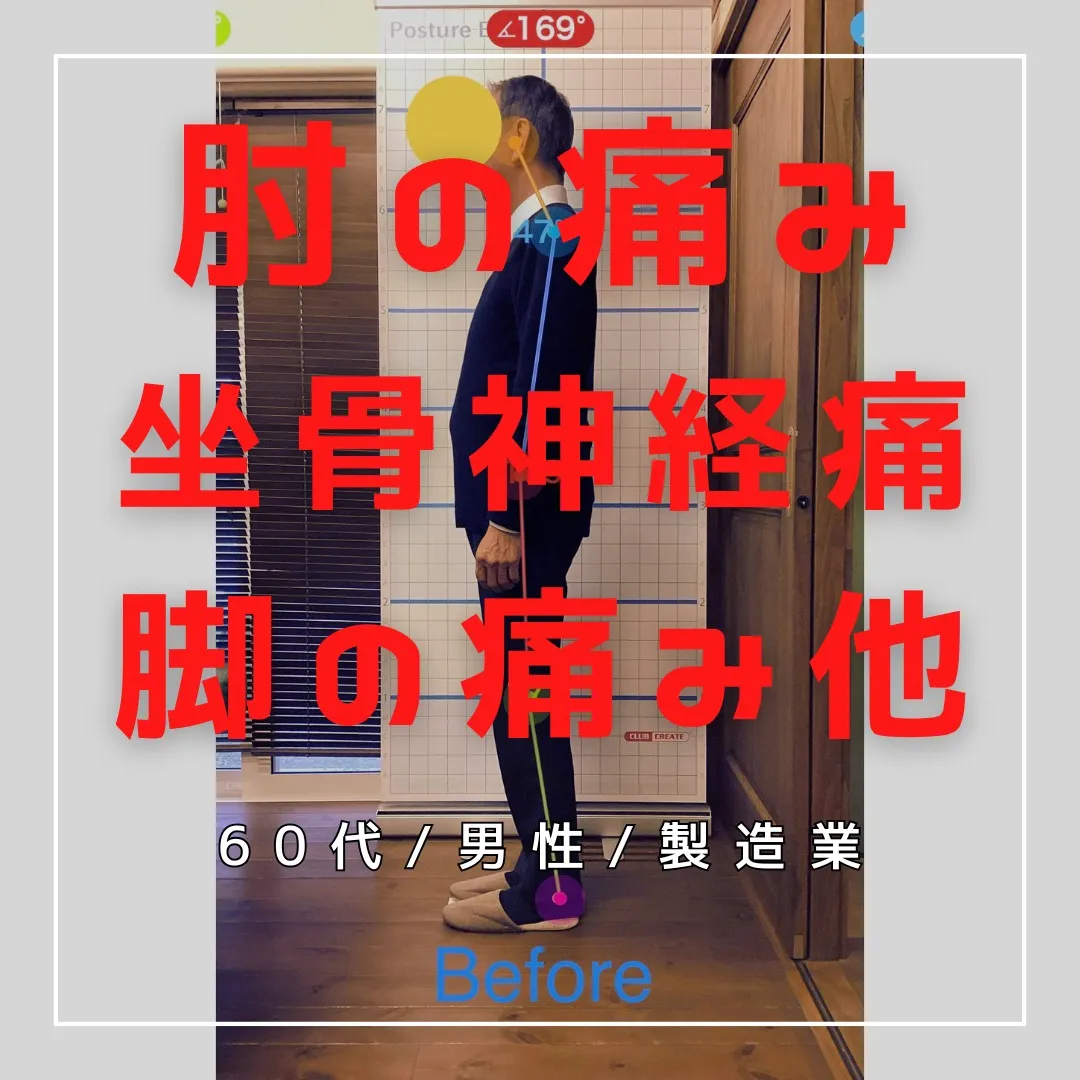 【富里 整体】坐骨神経痛、脚の痛み、肘の痛み/60代男性/製...