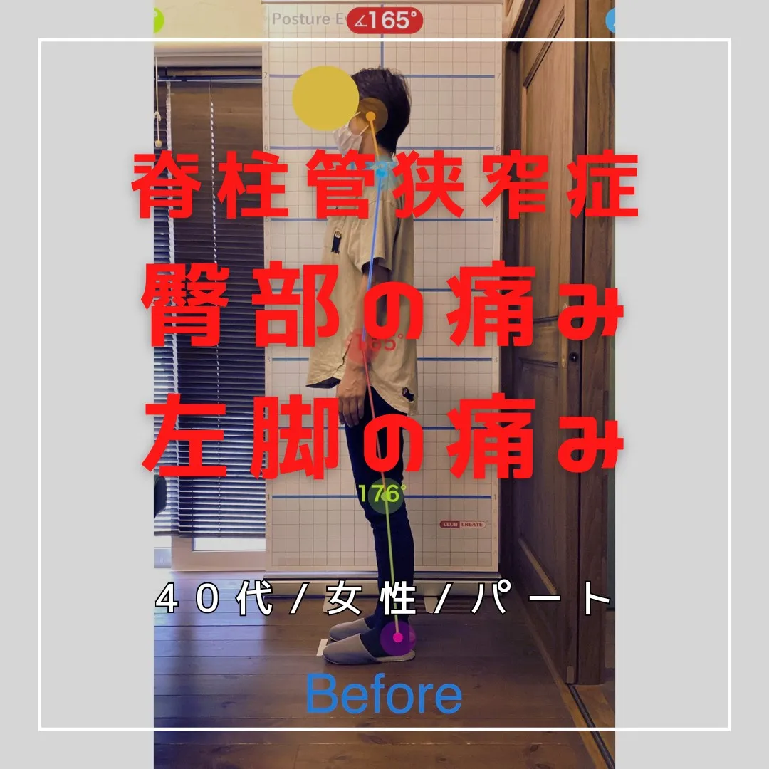 【富里 整体】脊柱管狭窄症、臀部の痛み、左脚の痛み 他/40...