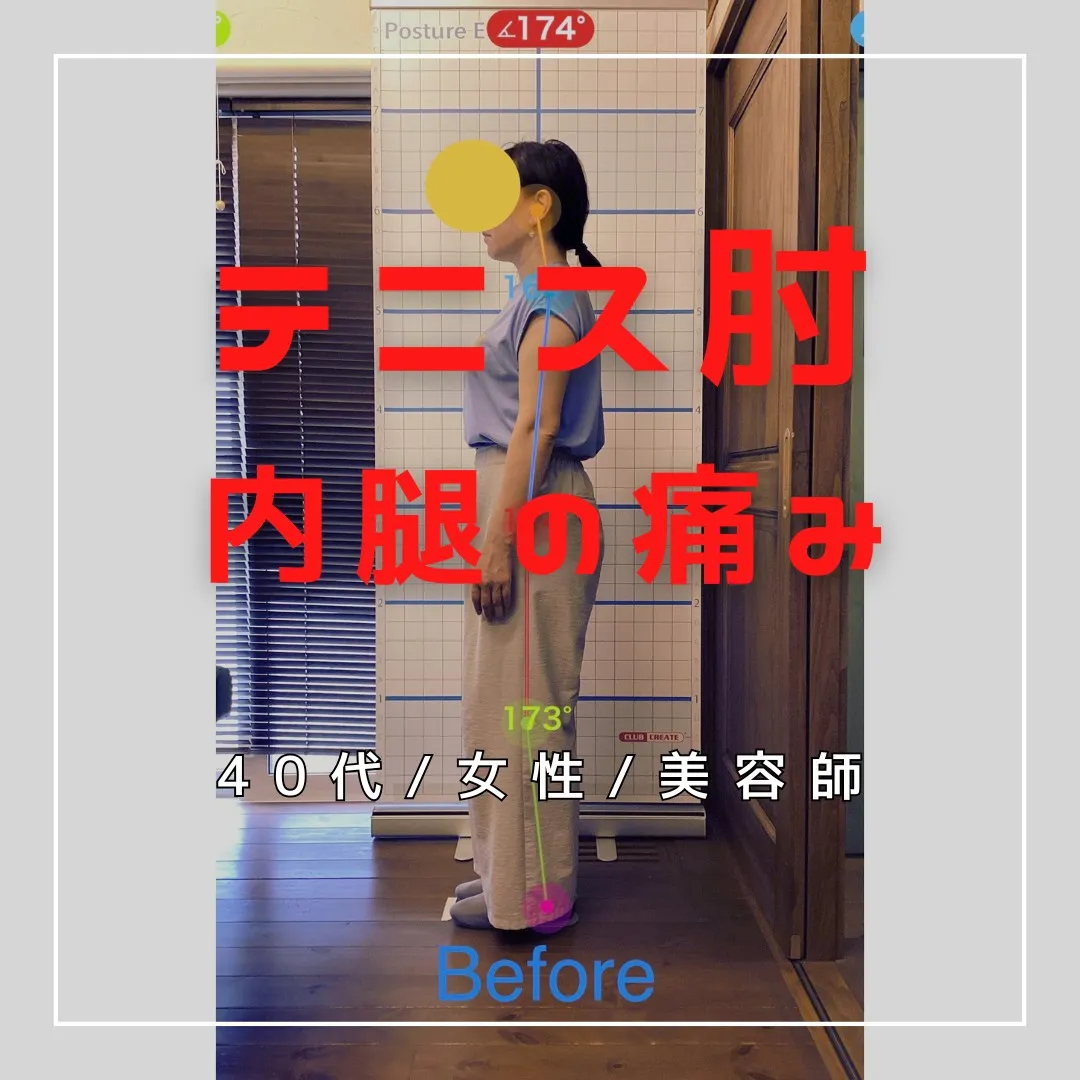 【富里 整体】内腿の痛み、腕の痛み(テニス肘)/40代女性/...