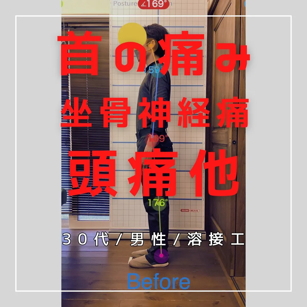 【富里 整体】首の痛み、頭痛、坐骨神経痛 他/30代男性/溶...