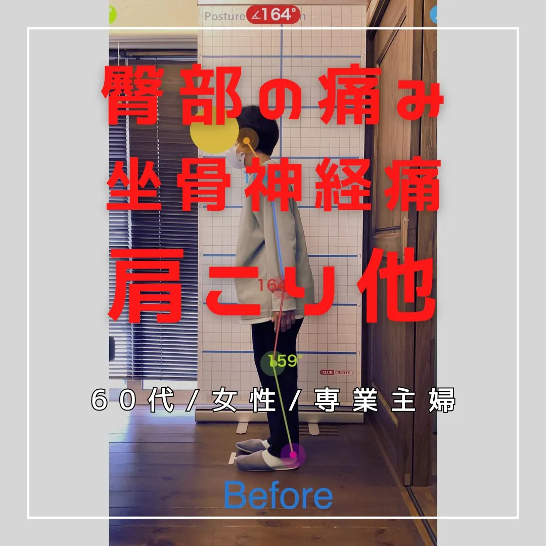 【富里 整体】坐骨神経痛、臀部の痛み、肩こり 他/60代女性...