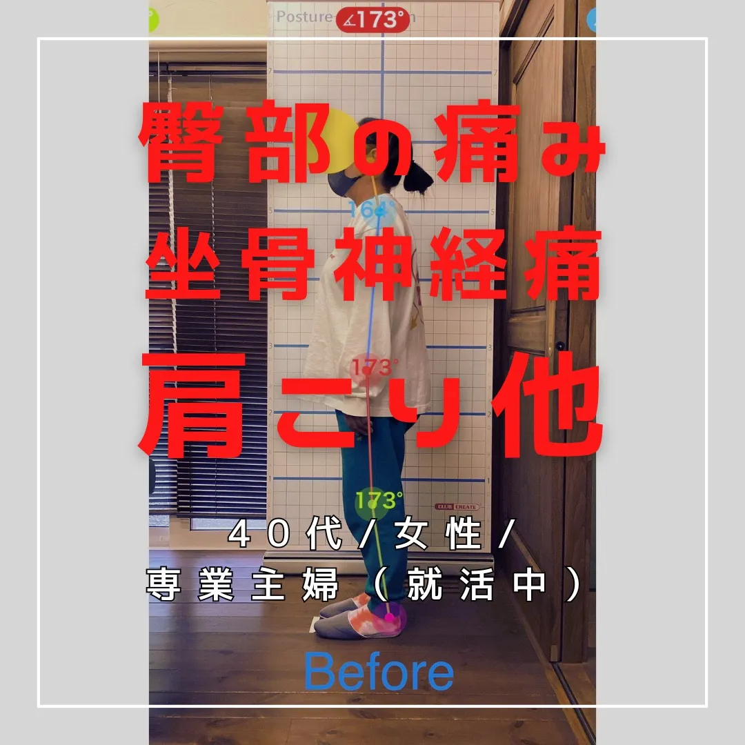 【富里 整体】坐骨神経痛、臀部の痛み、肩こり 他/40代女性...