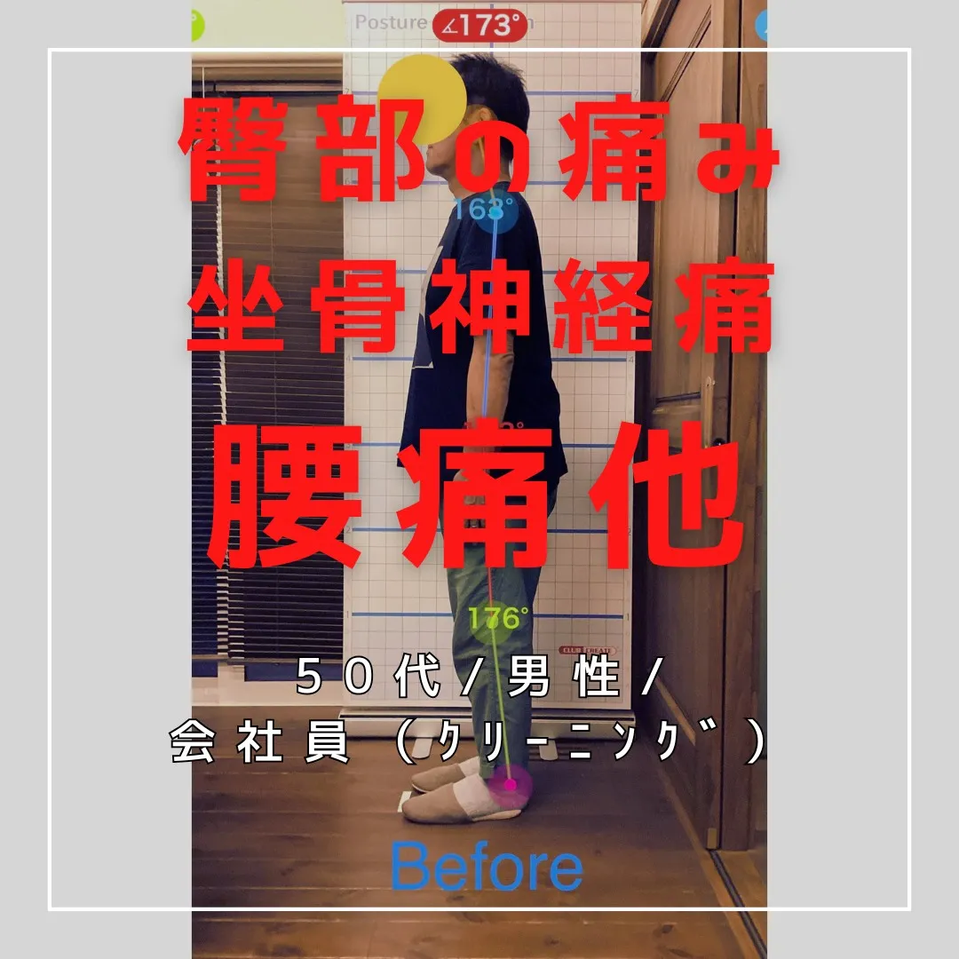 【富里 整体】坐骨神経痛、腰痛、臀部の痛み 他/50代男性/...